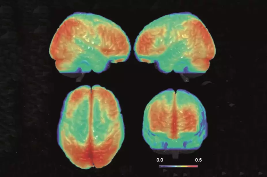 IMAGING OF A BIPOLAR BRAIN